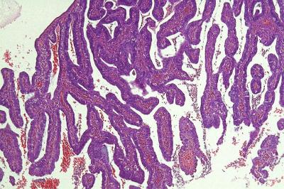 Figure 1: Exophytic tumour composed of villous and papillary architecture (H&E, 10x  magnification)